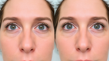 Patient's eyes demonstrating concealed eyelids before and open eyelids after Oberlidstraffung Zürich, highlighting aesthetic enhancement.